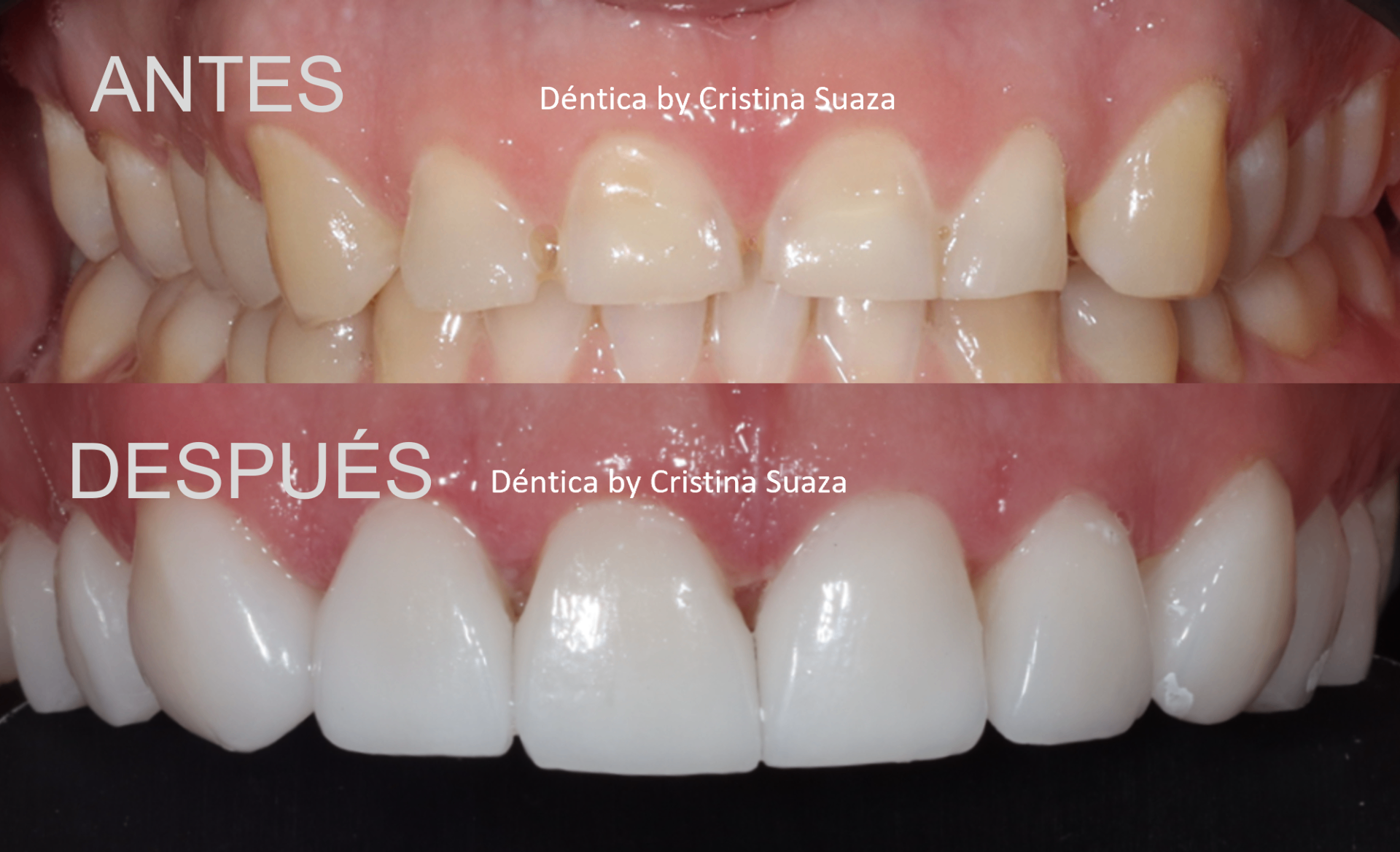 Smile design before and after