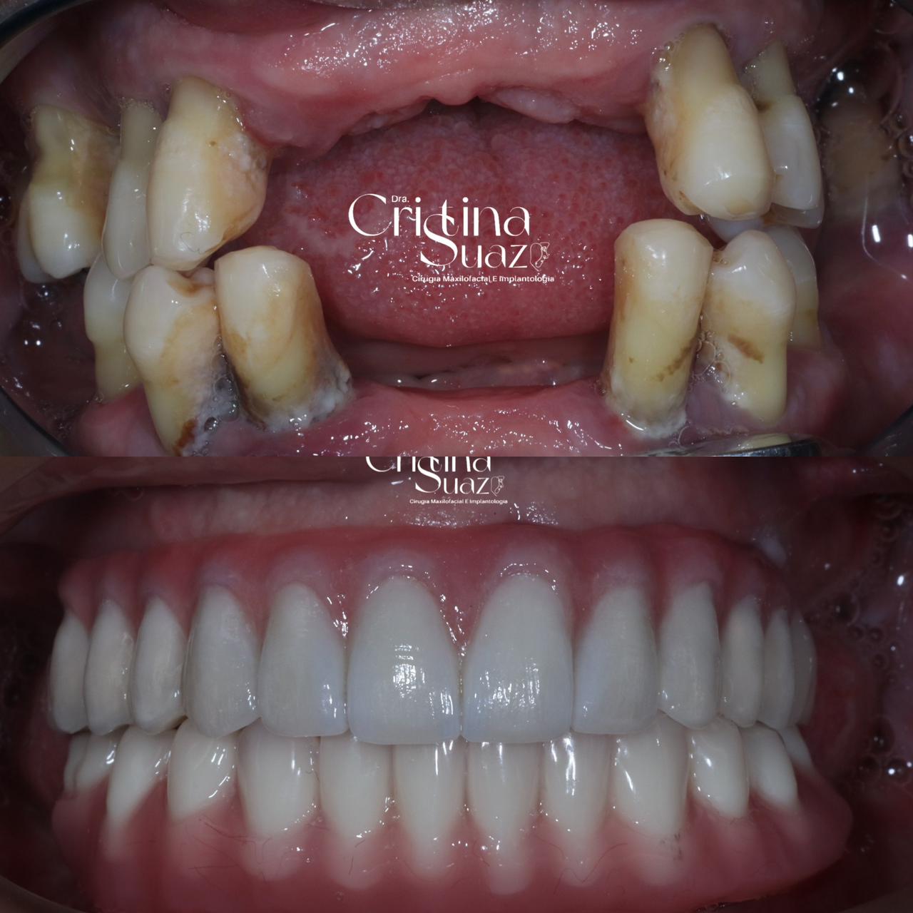 All-on-X full arch before and after